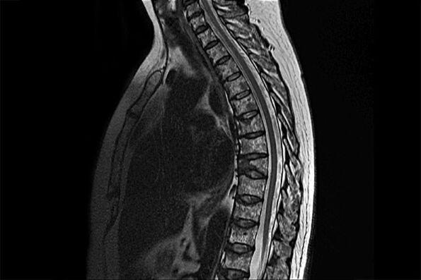 Manifestacije torakalne osteohondroze na slici MRI