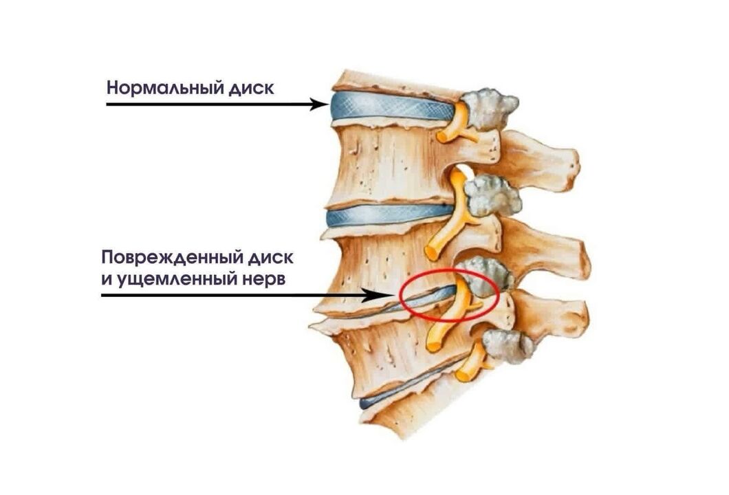 Simptomi cervikalne osteohondroze