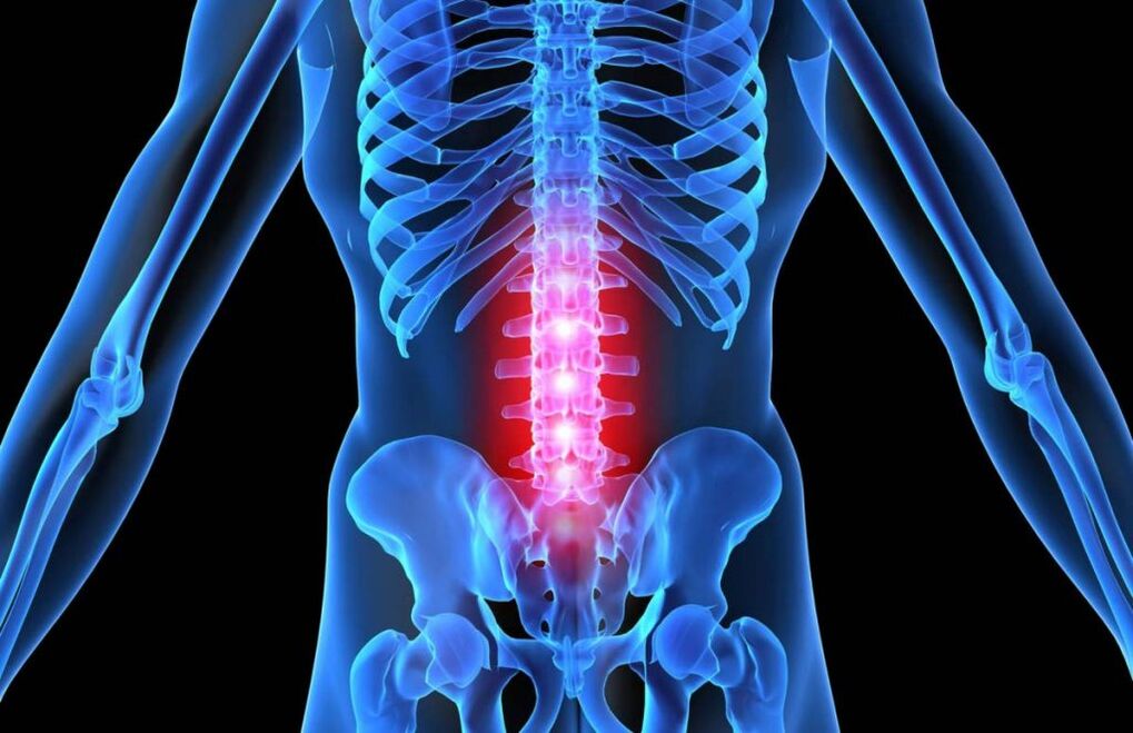 Osteohondroza lumbalne kralježnice