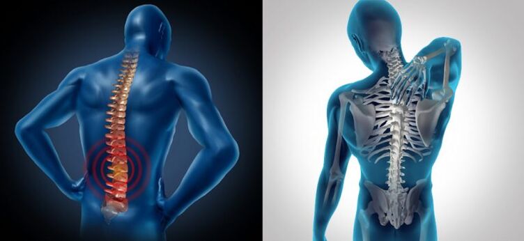 Upala u kičmenoj osteohondrozi