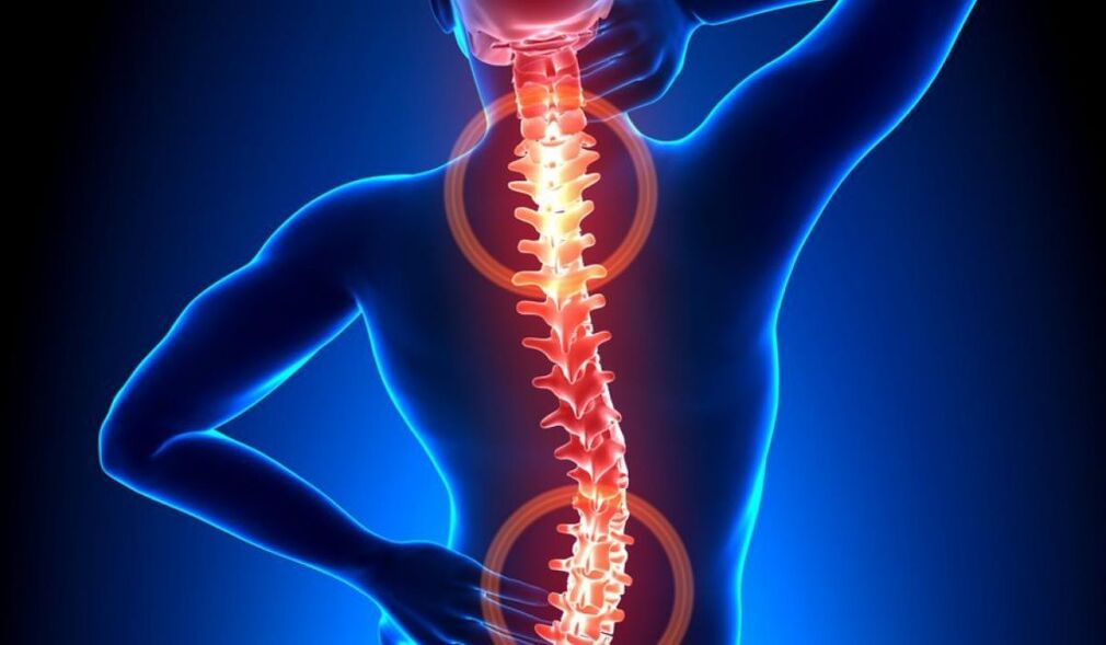 osteohondroza kralježnice