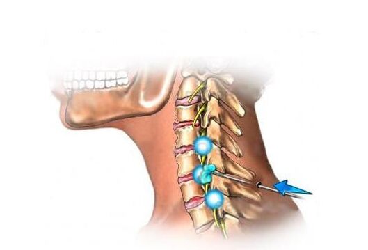 Liječenje cervikalne osteohondroze